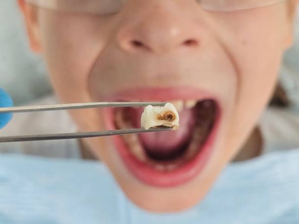 Best Broken or Chipped Tooth Repair in Millersville, PA